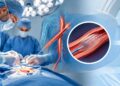 The Shift to Endovascular, Minimally Invasive Care